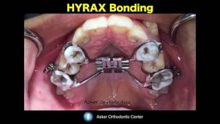 bonding HYRAX expander in orthodontics- maxilla expansion-orthodontic education and courses