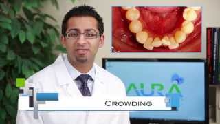 Braces: Common Cases, Crowding, Under Bite, Cross Bite – Aura Orthodontics