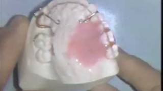 Orthodontic Acrylic Technique