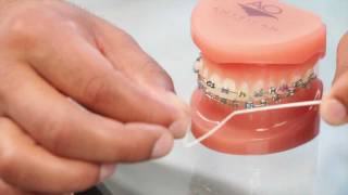 Braces: Brushing Braces, Flossing How To – Aura Orthodontics