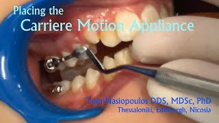 Carriere Placement | Tom Nasiopoulos, Orthodontist