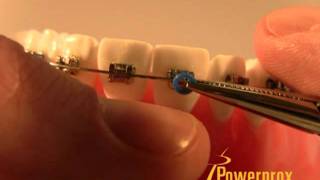 How to Tie an O-Ring Elastic Powerprox Six Month Braces Orthodontic Education Video