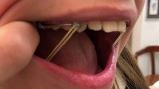 CARRIERE MOTION APPLIANCE | Tom Nasiopoulos Orthodontist