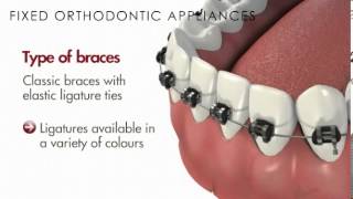 Malocclusion/Fixed Orthodontic Appliances(Braces)