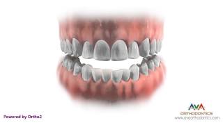 Orthodontics Treatment with Extraction – Removing Different Teeth