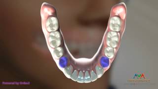 Orthodontic Treatment for Underbite or Crossbite – Removing Lower 1st Premolars