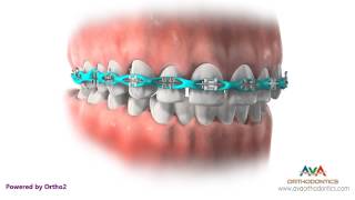 Space Closure by Power Chain – Orthodontic Treatment