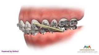 Orthodontic Treatment for Overjet (Overbite) – Rubber Bands