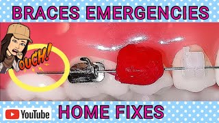 Braces Emergencies! – Fixes! How To Fix Broken Braces at Home if Orthodontist is Closed