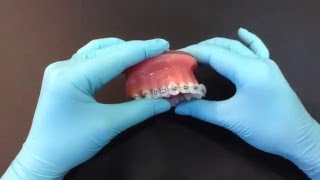 How to use orthodontic wax