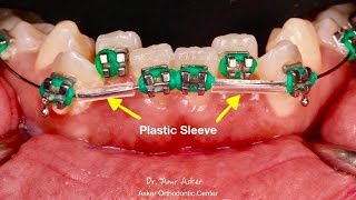 plastic sleeve in orthodontics , episode no. 4, Quick orthodontic tips series, Dr. Amr Asker