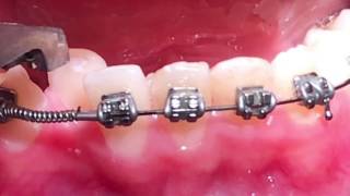 Crimpable stop-open coil spring- orthodontics