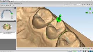 Maestro 3D Orthodontics Design Software-Invisible Aligner