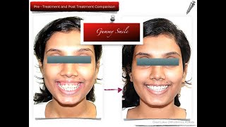 [ABHISHEK GHOSH ORTHO] GUMMY SMILE CORRECTION WITH TADS- ORTHOGNATHIC SURGERY LIKE ORTHODONTICS