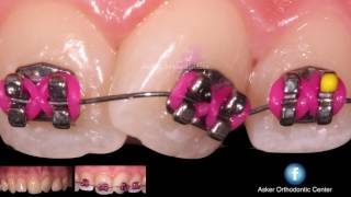 Treatment of Rotation in orthodontics ,Orthodontic lecture by dr. Amr Asker