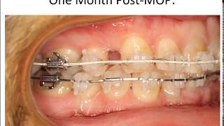 Orthodontic Treatment: Accelerated Orthodontics May 23, 2017