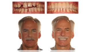 Dental Treatment: Accelerated Orthodontics Dec 5, 2017