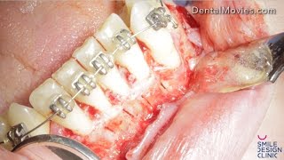 Periodontally accelerated orthodontic tooth movement procedure