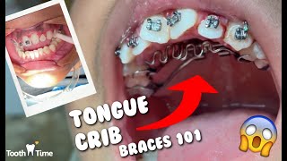 Dental Braces: Tongue Crib + RPE  – Tooth Time New Braunfels Texas Orthodontics