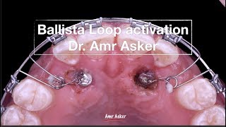 ballista loop activation in orthodontics, impacted canine traction Dr. Amr Asker