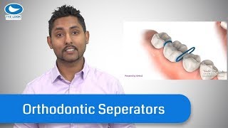 Orthodontic Separators/Spacers – What they are, and TIPS.