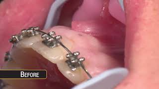 Gemini Diode Laser Step-by-Step: Gingivectomy and Frenectomy for Orthodontics