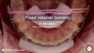 fixed permanent retainer bonding in orthodontics by dr. Amr asker