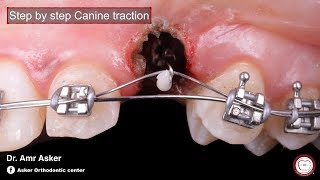 Step by step surgical exposure and orthodontic traction of impacted canine by Amr Asker