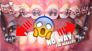 Dental Braces: HERBST Appliance – Tooth Time New Braunfels Texas Orthodontics