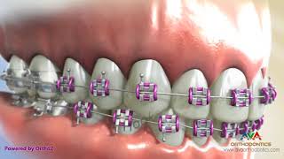 Orthodontic Braces – Different Parts (2)