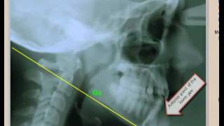 Simplified   cephalometric analysis for  orthodontic treatment