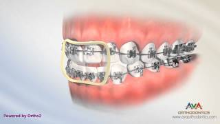 Orthodontic Treatment for Openbite – Rubber Bands