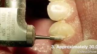 how to remove adhesive (composite) after debonding orthodontic brackets