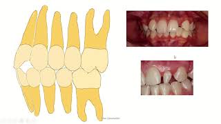 Bolton analysis for orthodontic undergraduate students