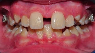 HYRAX EXPANDER GAP | Tom Nasiopoulos Orthodontist