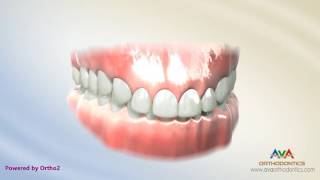 Orthodontic Treatment for Deepbite – Wire with Reverse Curve of Spee