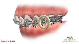 Orthodontic Rubber Bands – If Not Worn As Instructed