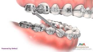 Orthodontic Treatment for Overjet (Overbite) – Forsus Appliance