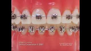 Advanced Orthodontics – Self Ligating Brackets