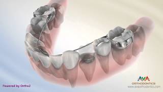 Orthodontic Space Management – Lingual Arch Appliance