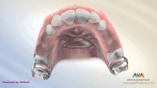 Orthodontic Space Management – Nance Appliance