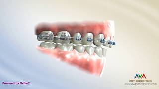 Orthodontic Treatment for Deepbite – Wire with Step Bends