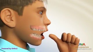 Orthodontic Treatment for Thumb Sucking – Habit Breaker Appliance