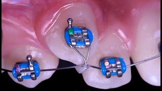 Distant ligature traction in orthodontics