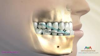 Orthodontic Treatment for Underbite or Crossbite – Carriere Appliance