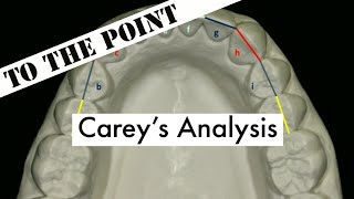 Carey's Model Analysis | Orthodontics | NEET | INBDE | Bhaumik Joshi | Aspire MDS