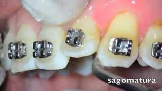 Orthodontic Stripping – Tooth Stripping – Sonostripping Tips – Sonosurgery