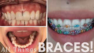 My Orthodontist Closed! Braces update: Do I regret it?