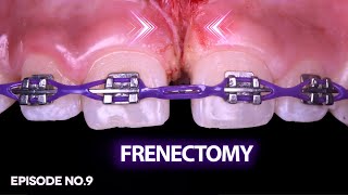 Frenectomy and its relation to orthodontics , episode No.9 , quick orthodontic tips series . QOT