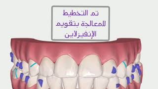 orthodontic treatment without metal braces…invisalign